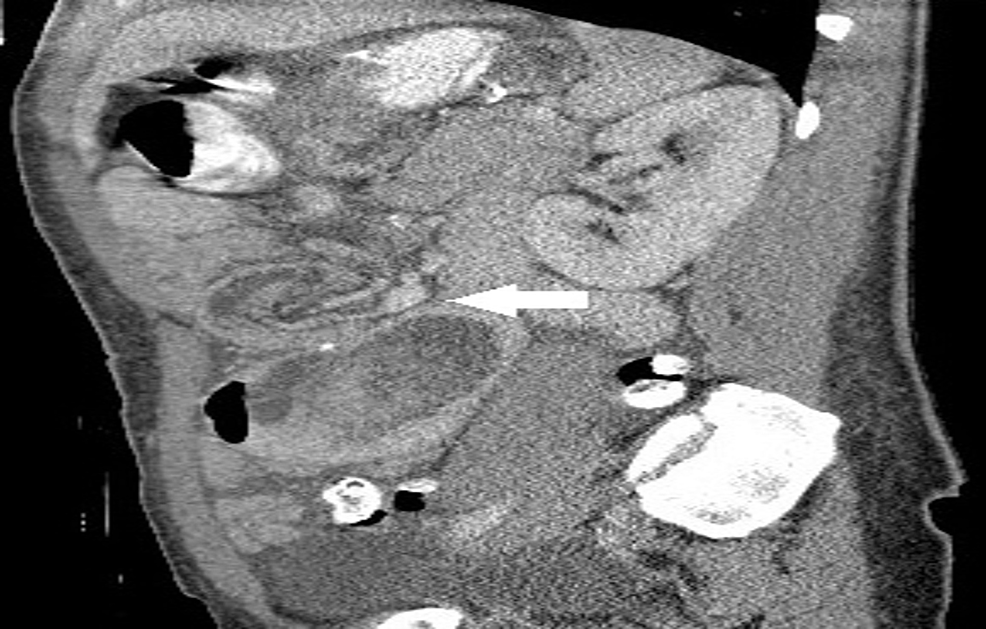 Cureus Retrograde Jejunojejunal Intussusception after RouxenY