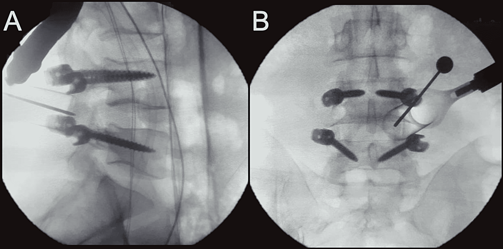 (A)-Sagittal-and-(B)-coronal-x-ray-images-of-the-lumbosacral-spine-after-bilateral-pedicle-screw-placement-at-the-L4/L5-segments-in-a-44-year-old-male-patient.