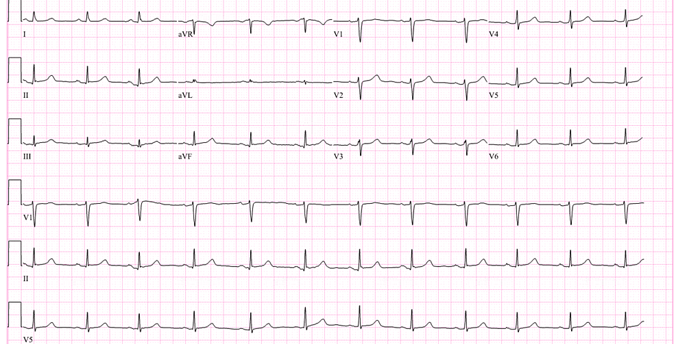 Electrocardiogram-showing-a-normal-sinus-rhythm