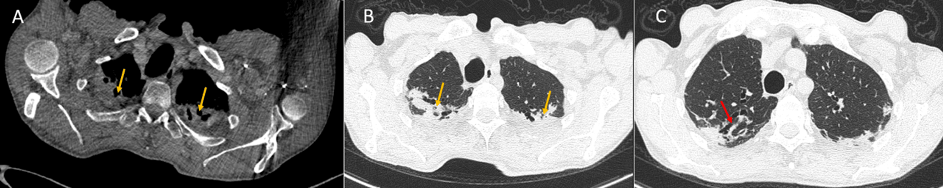 Cureus | Pleuroparenchymal Fibroelastosis: A Case Report