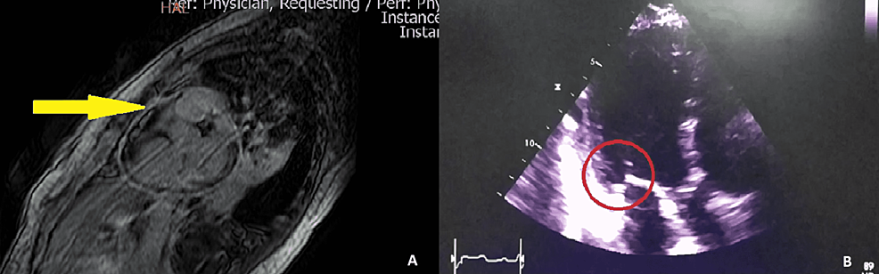 Cardiac-magnetic-resonance-and-transthoracic-echocardiogram