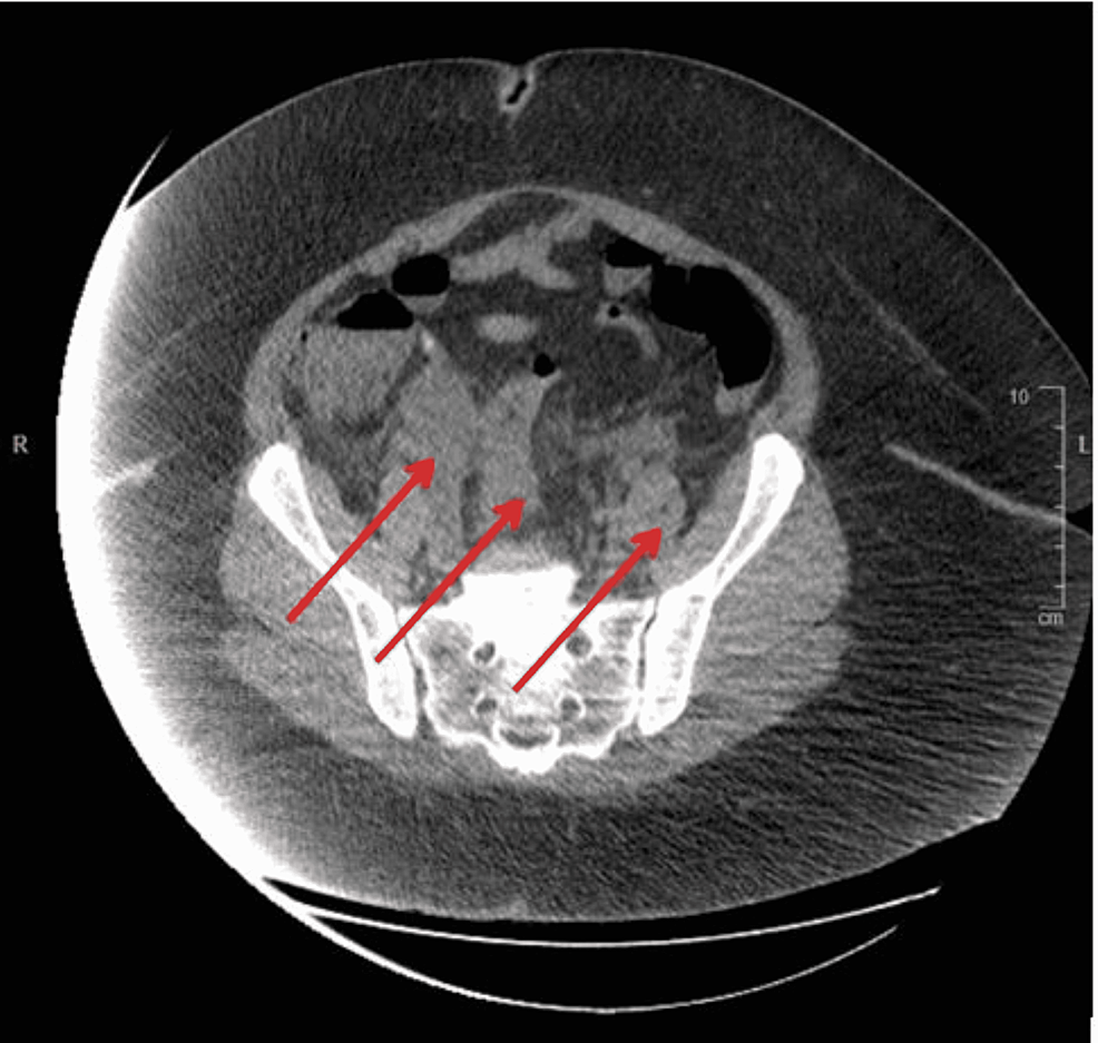 Cureus InteroExternal Hemorrhoids Complicated by IschioAnal