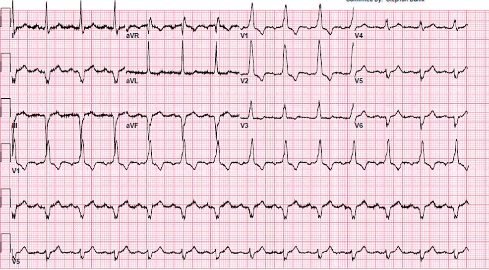 Delayed Total Atrioventricular Block After Transcatheter Aortic Valve  Replacement Assessed by Implantable Loop Recorders