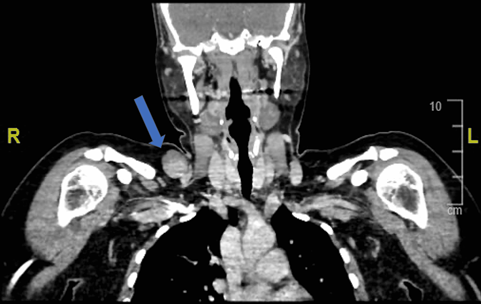 Figure 1 From External Jugular Vein Aneurysm Presenti - vrogue.co