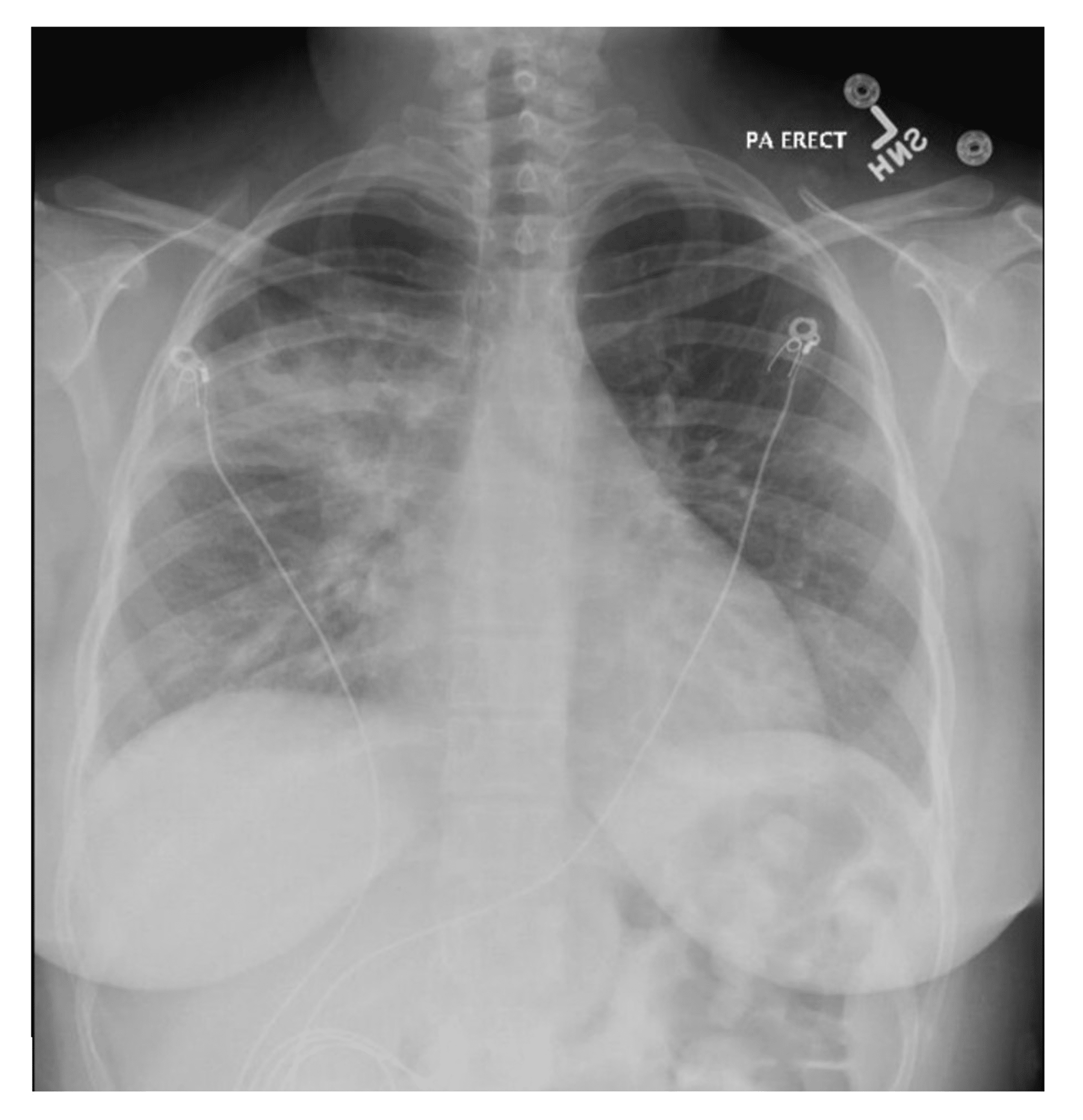 Cureus A Case Of Steroid Responsive Severe Pneumonia Following A   Lightbox 53071860e60d11ec9b8d536b6fb77667 Initial Cxr 