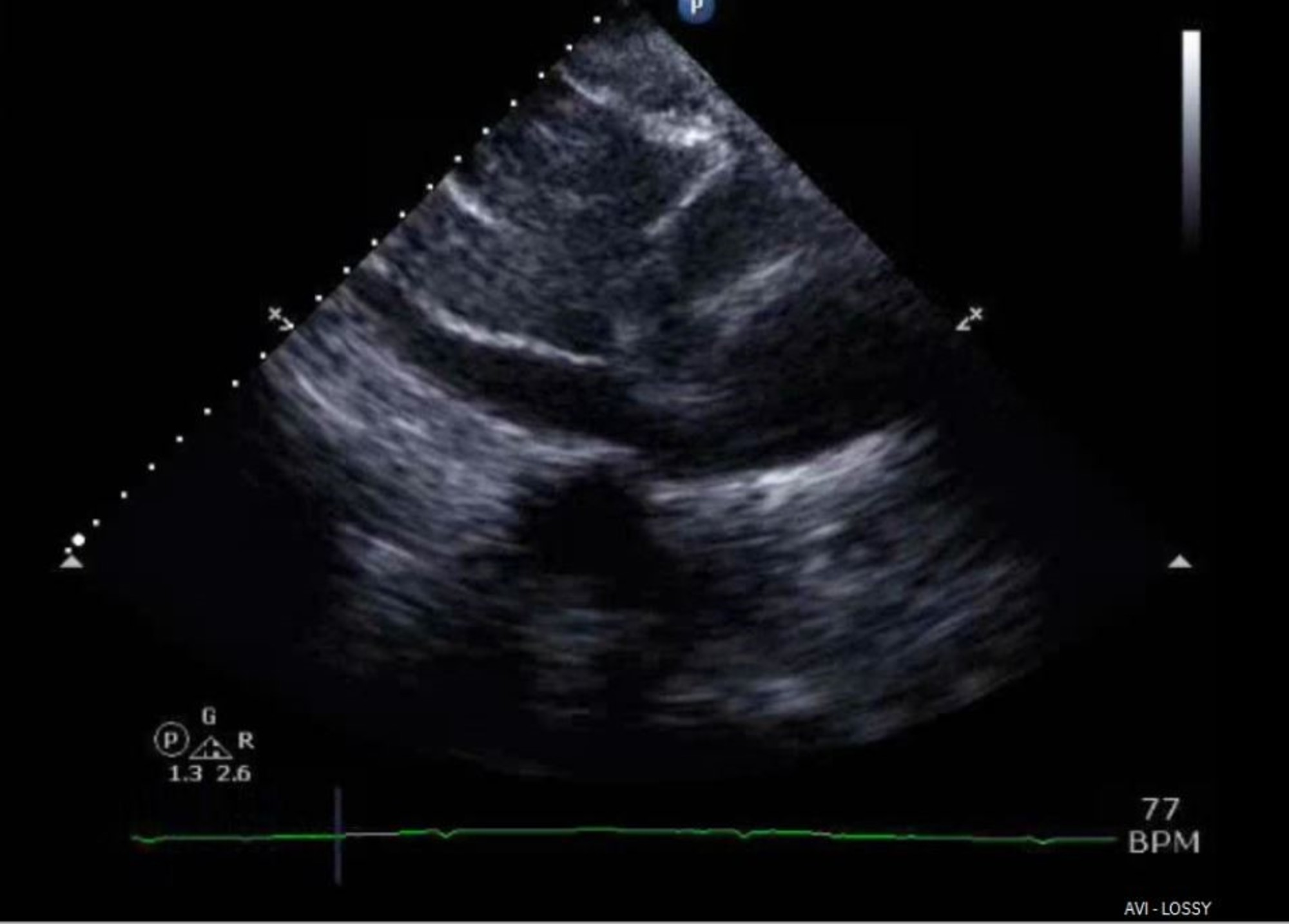 Cureus | Hypertensive Crisis in Cardiac Tamponade