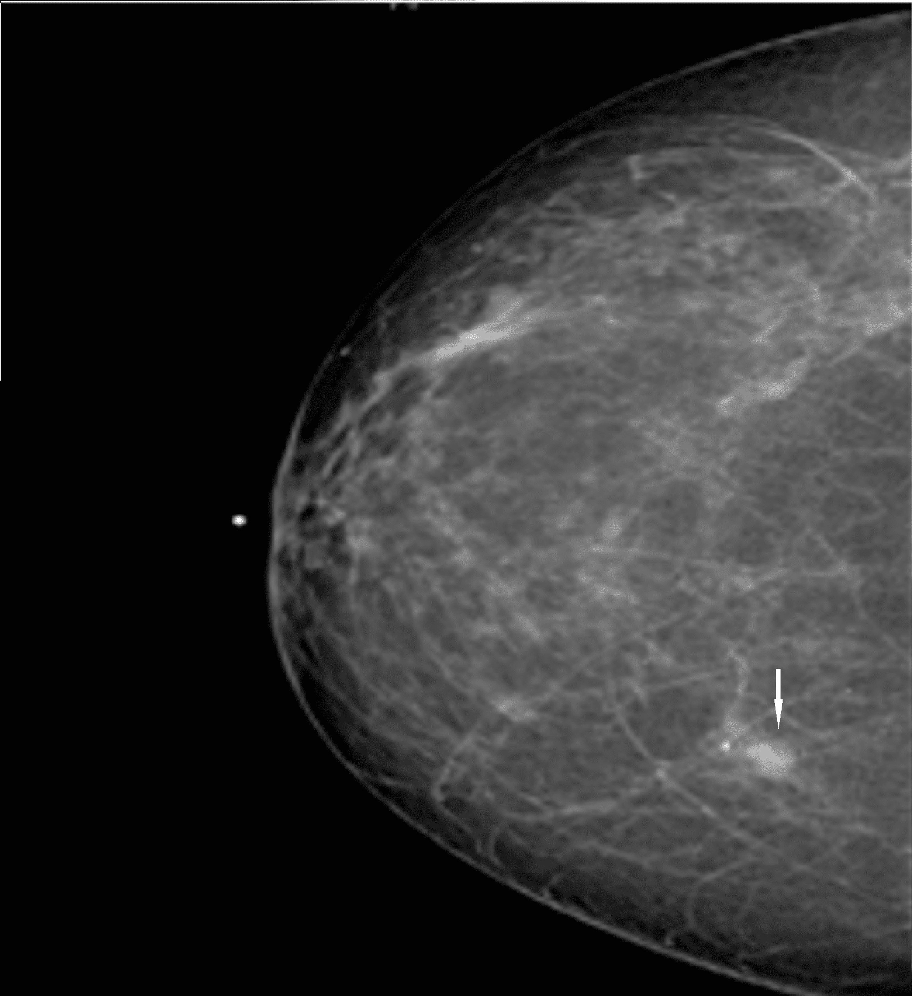 Cureus | Invasive Lobular Cancer Arising in a Surgical Scar From
