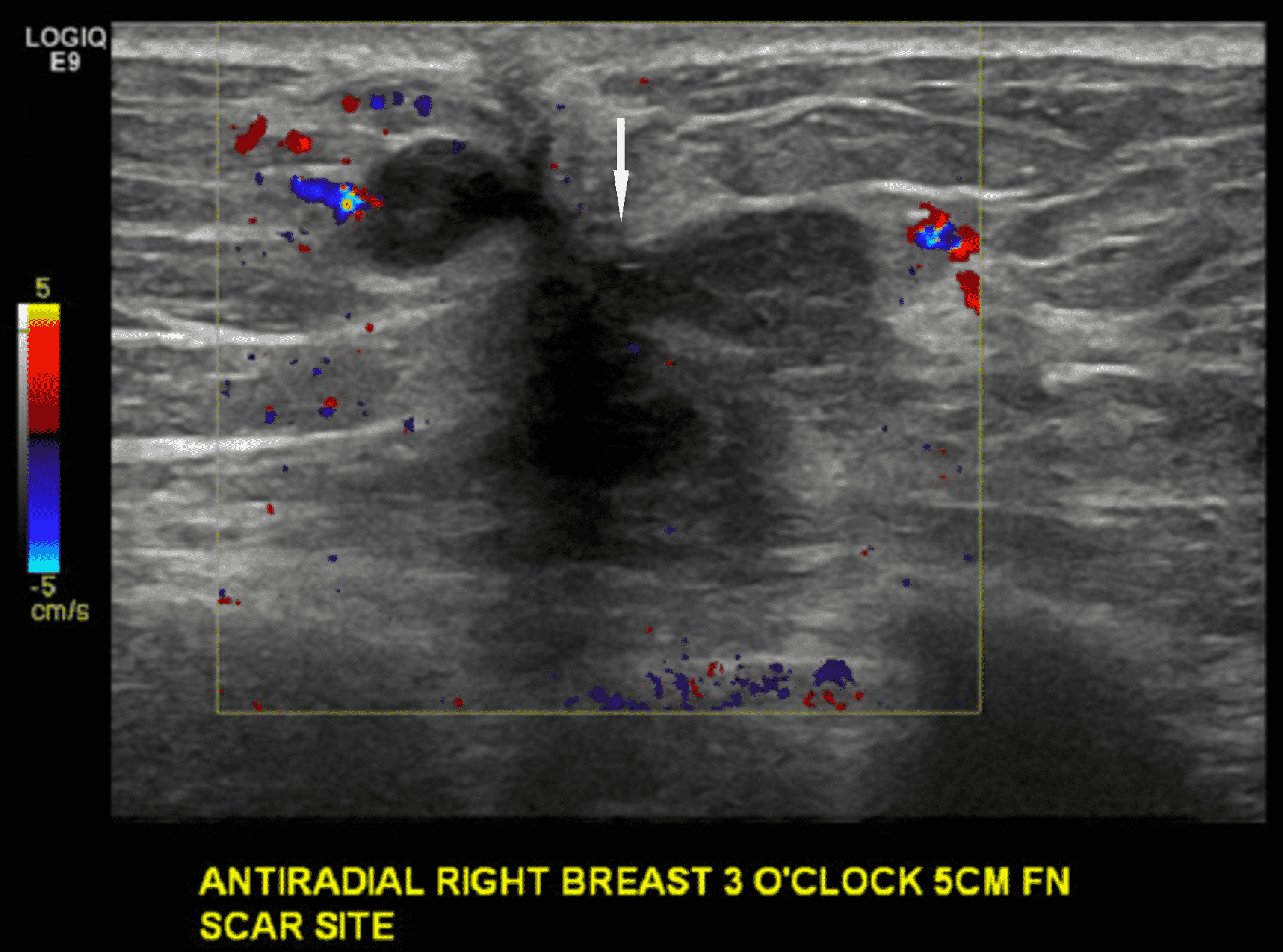 Cureus Invasive Lobular Cancer Arising in a Surgical Scar From