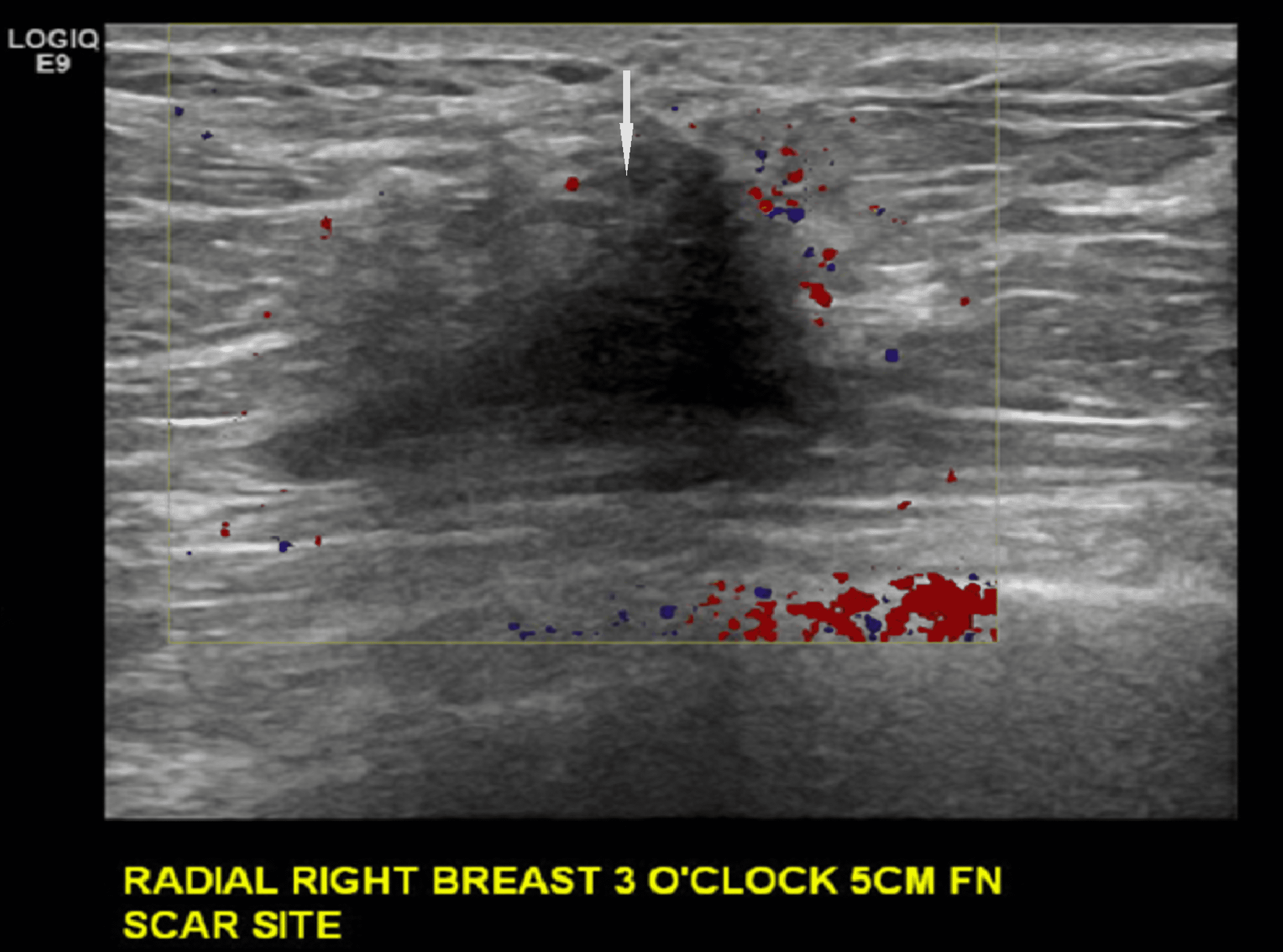 Invasive Lobular Cancer Arising in a Surgical Scar From Lumpectomy for