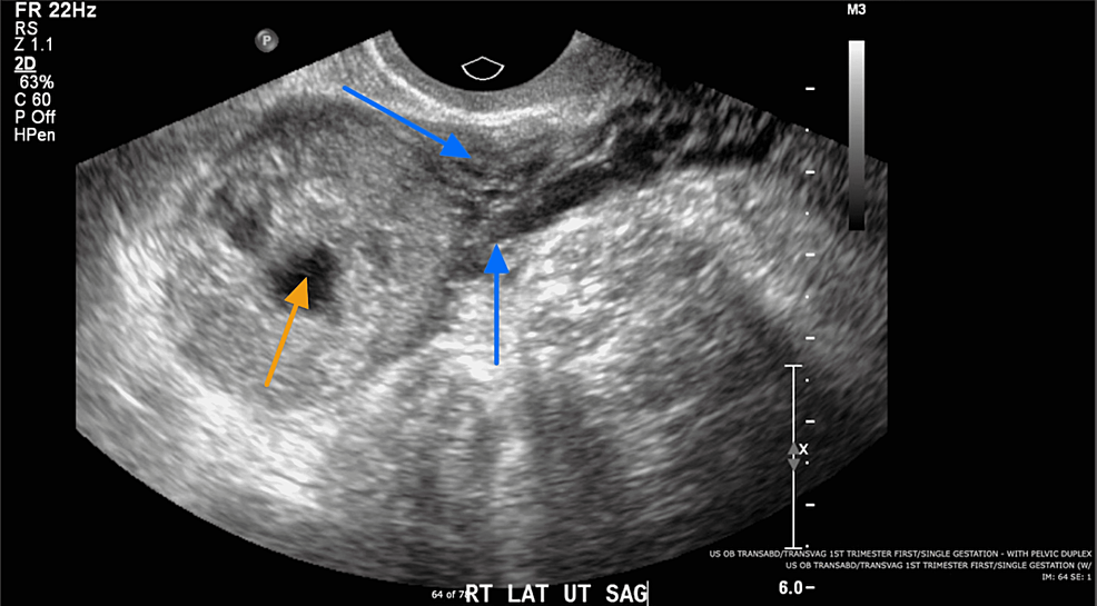 Ectopic Pregnancy: A Trainee's Guide to Making the Right Call: Women's  Imaging | RadioGraphics