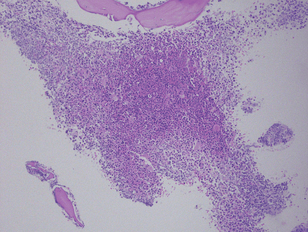 Hypercellularity-with-myeloid-hyperplasia-and-megakaryocyte-atypia-at-100x-power