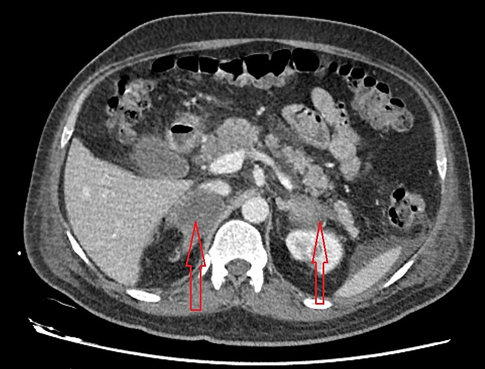 Cureus | A Rare Case of Bilateral Adrenal Hemorrhage