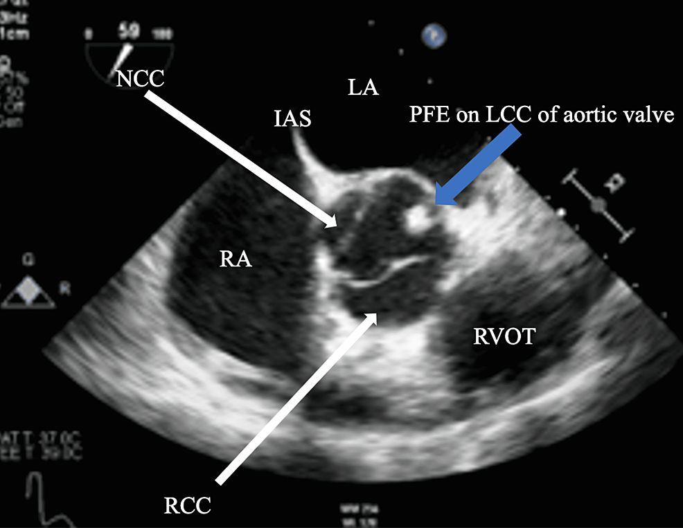 Widok śródprzełyku-TEE-pokazuje-fibroblastoma-fibroblast-na-lewej korony-wysunięcie zastawki aortalnej- (niebieska strzałka)