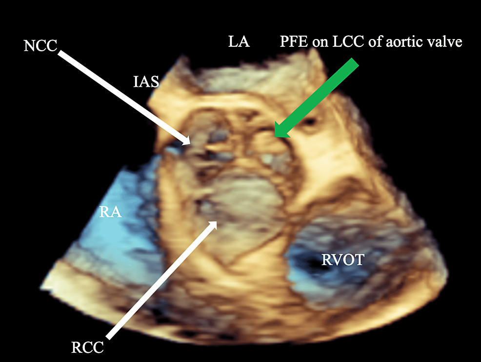 Widok 3D środkowej części przełyku ukazujący włókniaka brodawkowatego na lewym guzku mitralnym zastawki aortalnej (zielona strzałka)