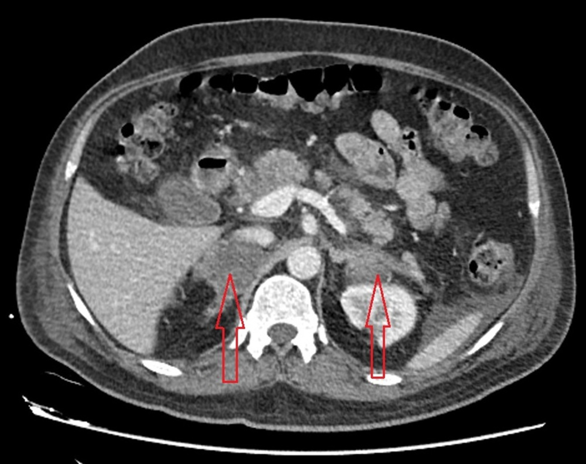 Cureus A Rare Case Of Bilateral Adrenal Hemorrhage