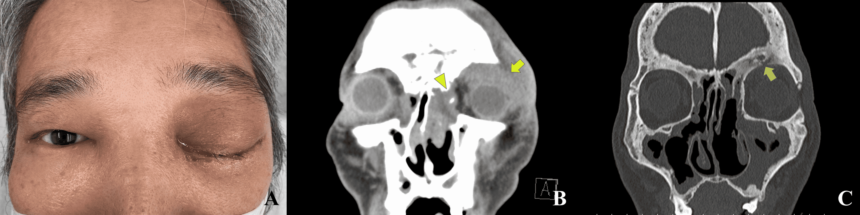 Cureus Orbital Abscess Developed Apart From Paranasal Sinusitis and