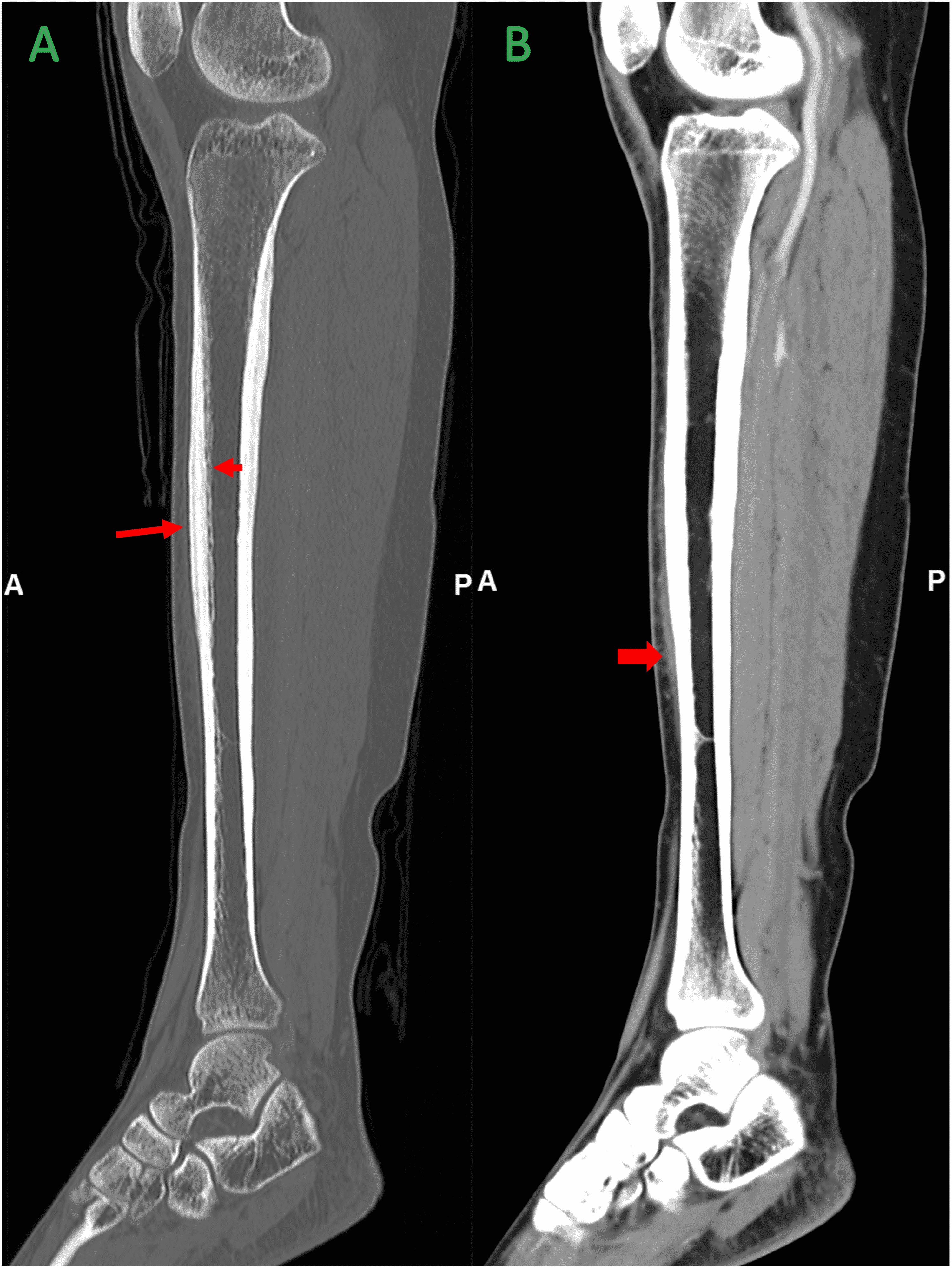 Cureus | Sclerosing Osteomyelitis of Garré: A Clinico-Radiological ...