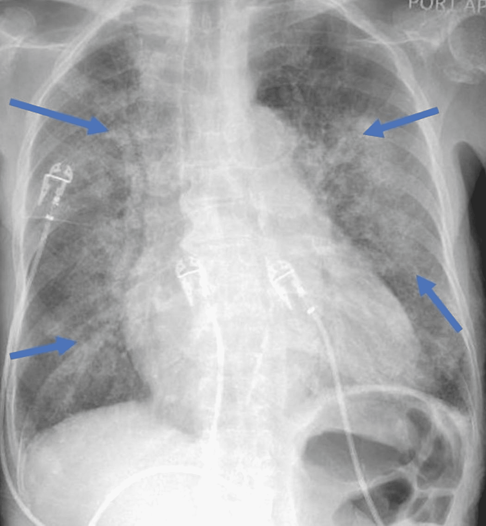 Chest-X-ray-showing-bilateral-patchy-infiltrates-and-ground-glass-opacities