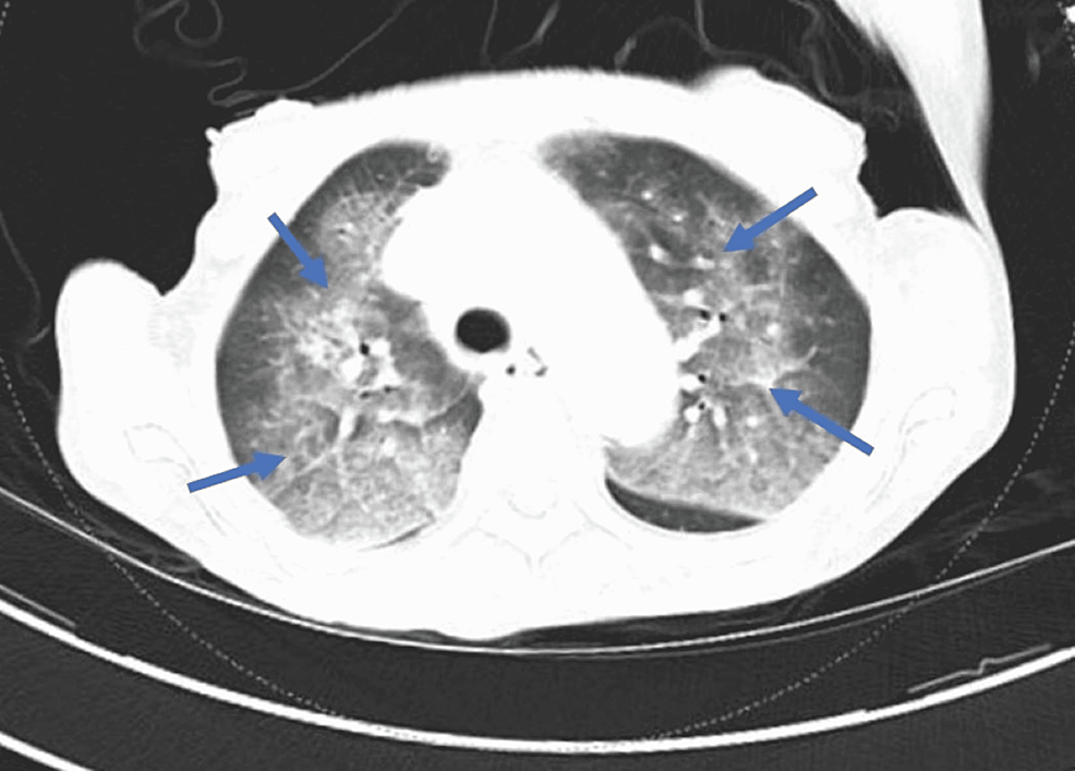 CT-chest-showing-septal-thickenings-and-patchy-acinar-opacities-in-the-perihilar-and-central-areas-of-both-lungs