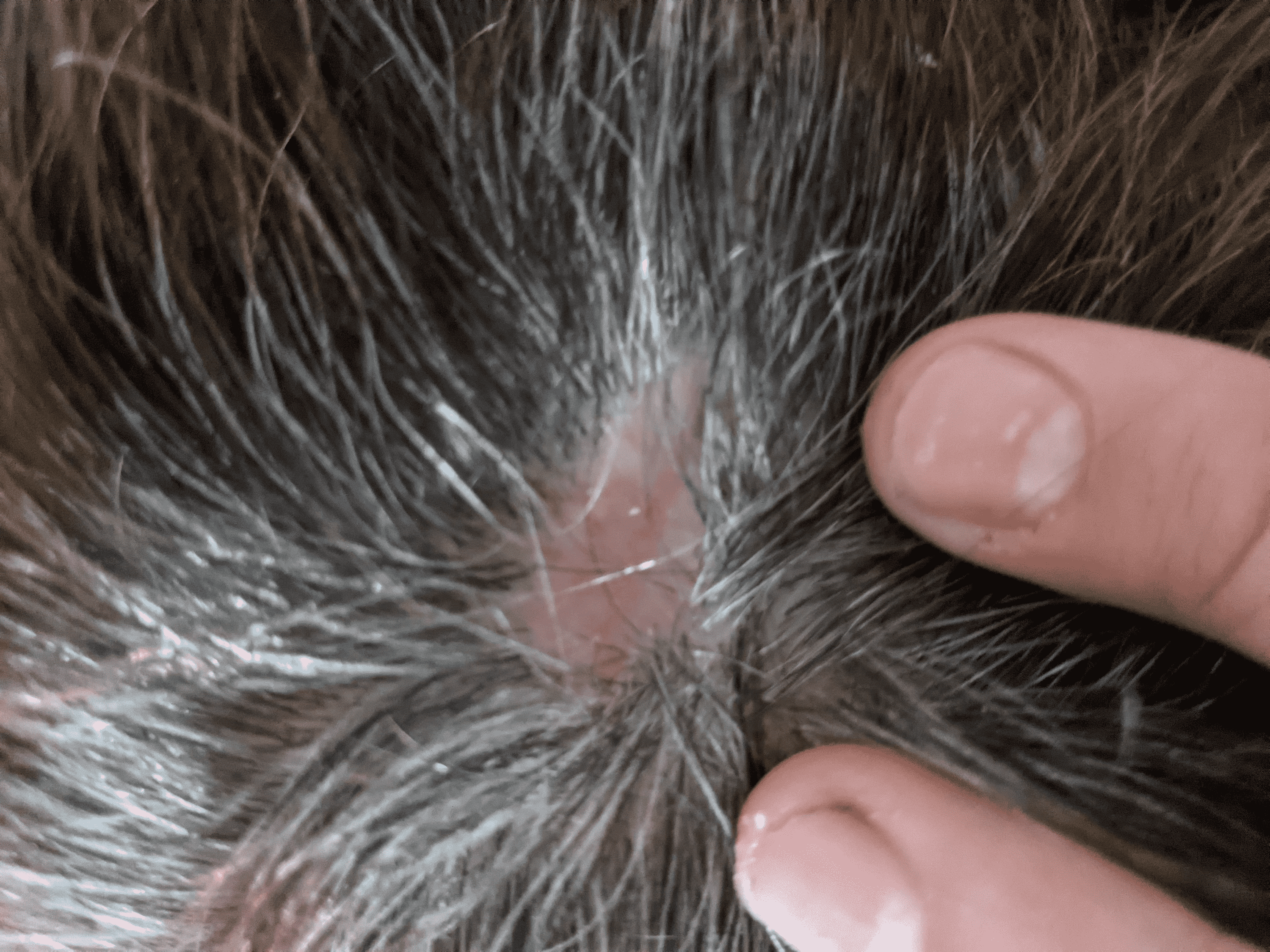 Cureus Basal Cell Cancer of the Scalp