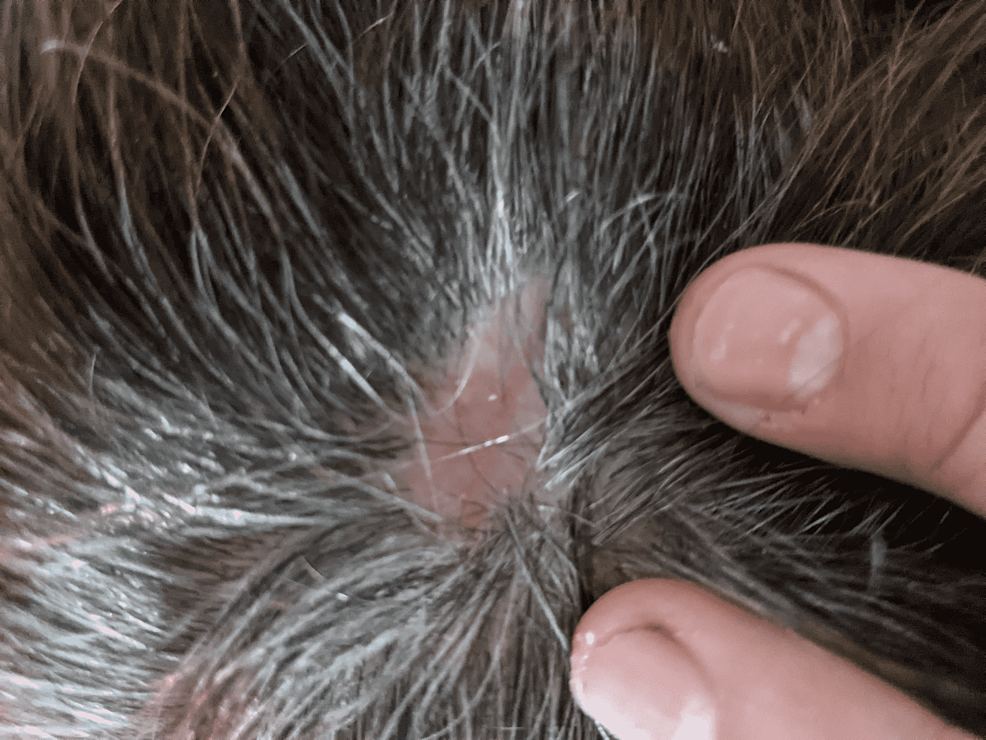 Cureus Basal Cell Cancer Of The Scalp