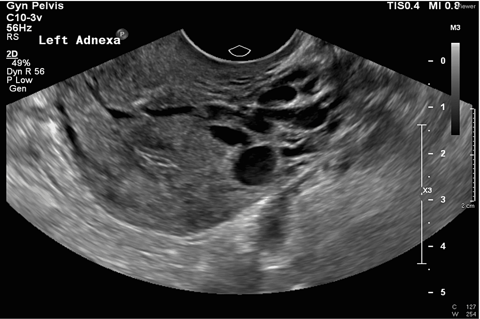 Flank pain radiating to the suprapubic region