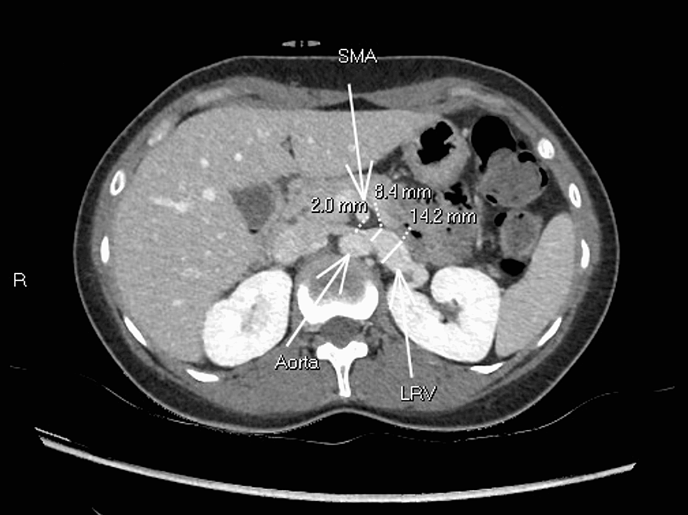 Cureus An Unusual Cause of Abdominal Pain in a MiddleAged Female