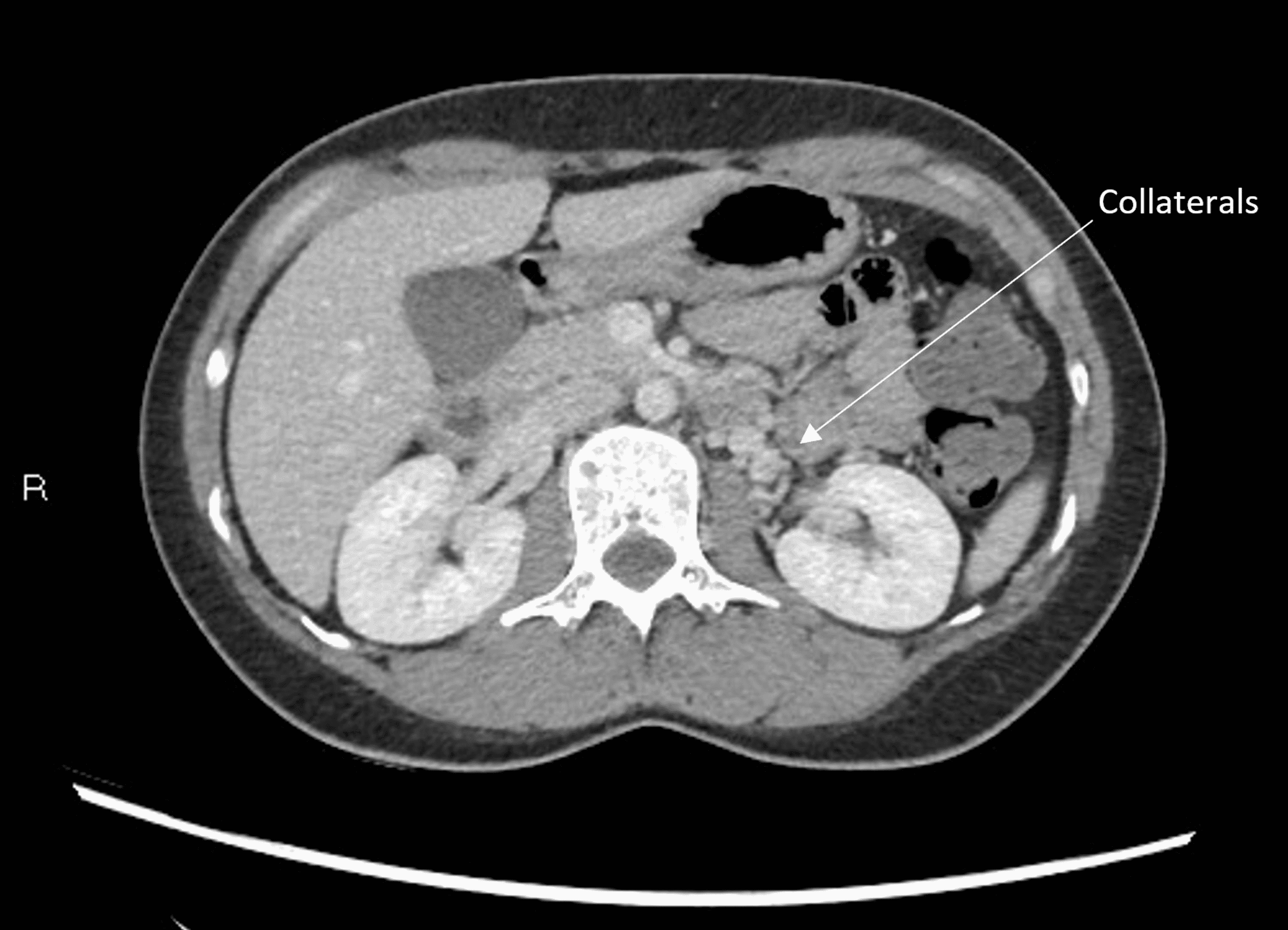 An Unusual Cause of Abdominal Pain in a MiddleAged Female The