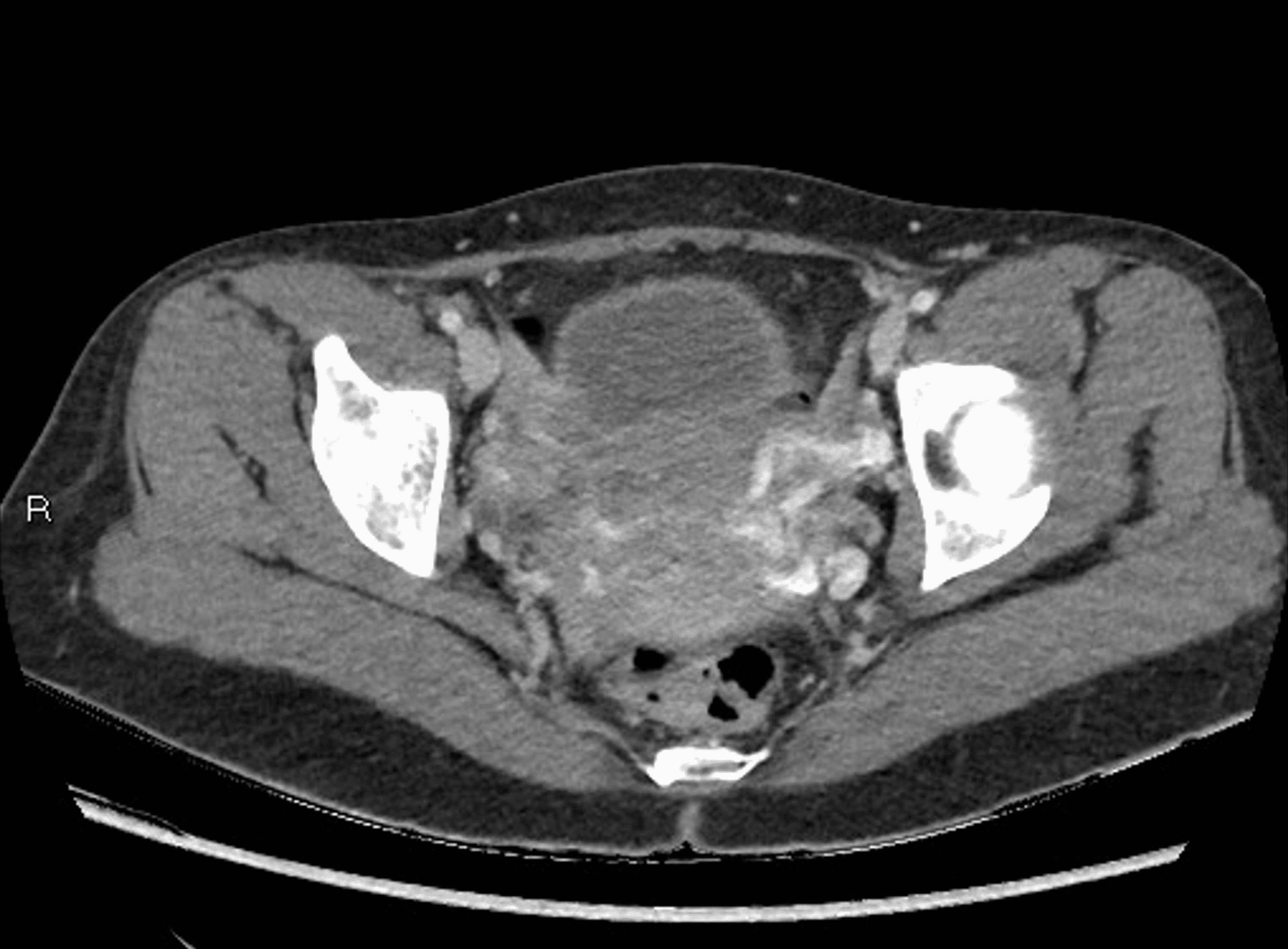 Cureus An Unusual Cause of Abdominal Pain in a MiddleAged Female The Nutcracker Syndrome