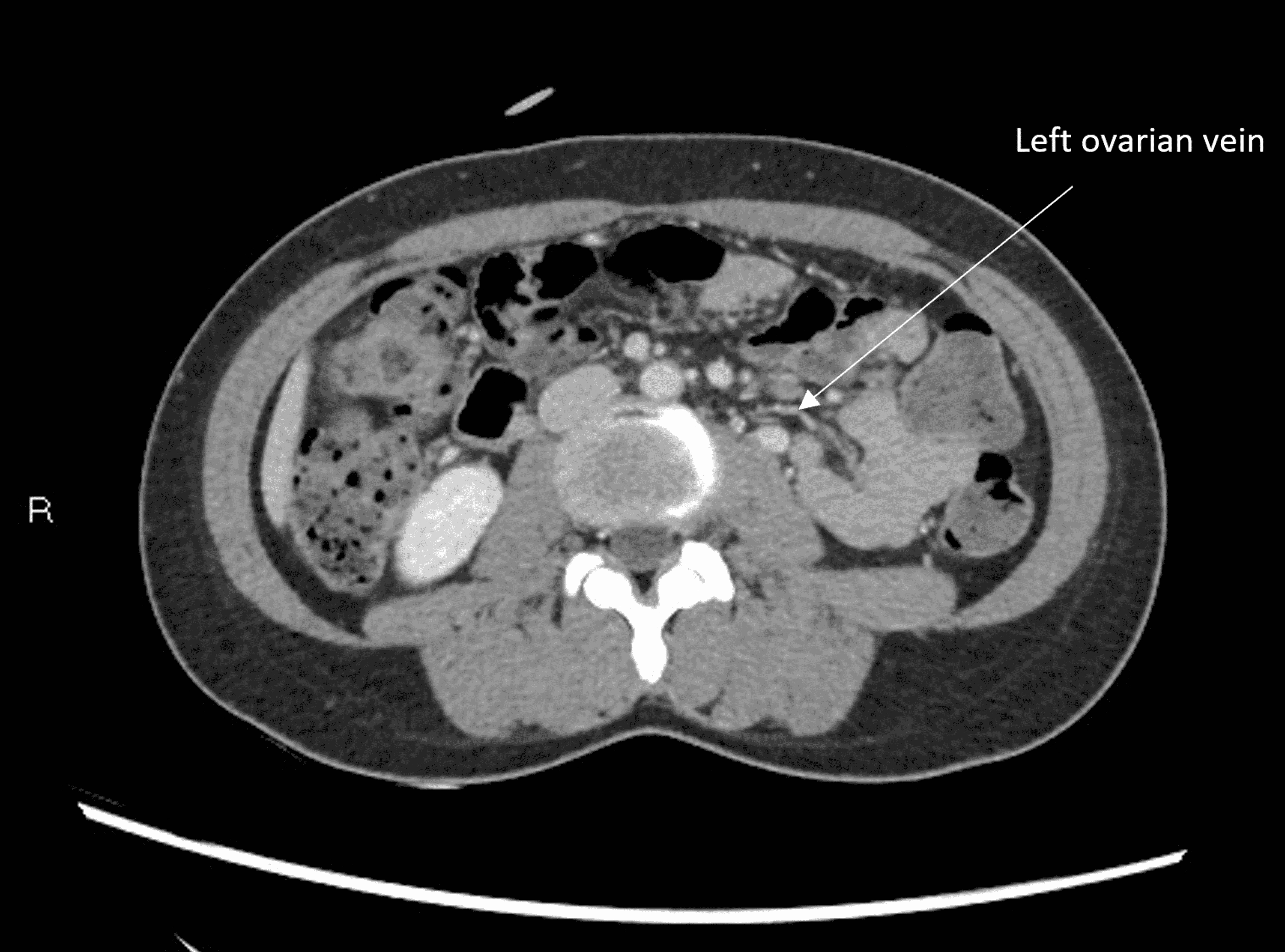 Cureus An Unusual Cause of Abdominal Pain in a MiddleAged Female The Nutcracker Syndrome