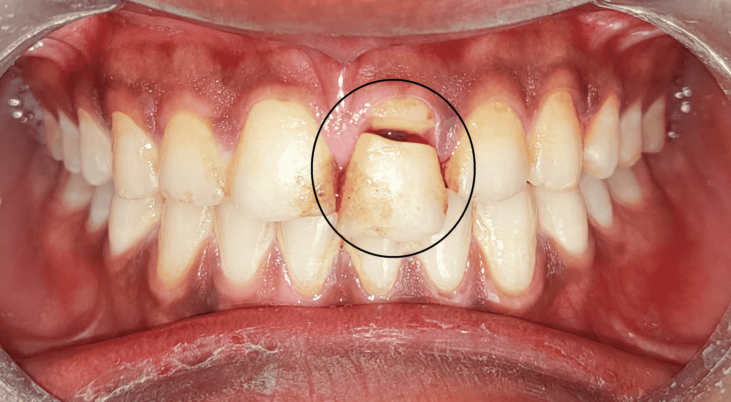Cureus Conservative Management of Complicated CrownRoot Fracture An