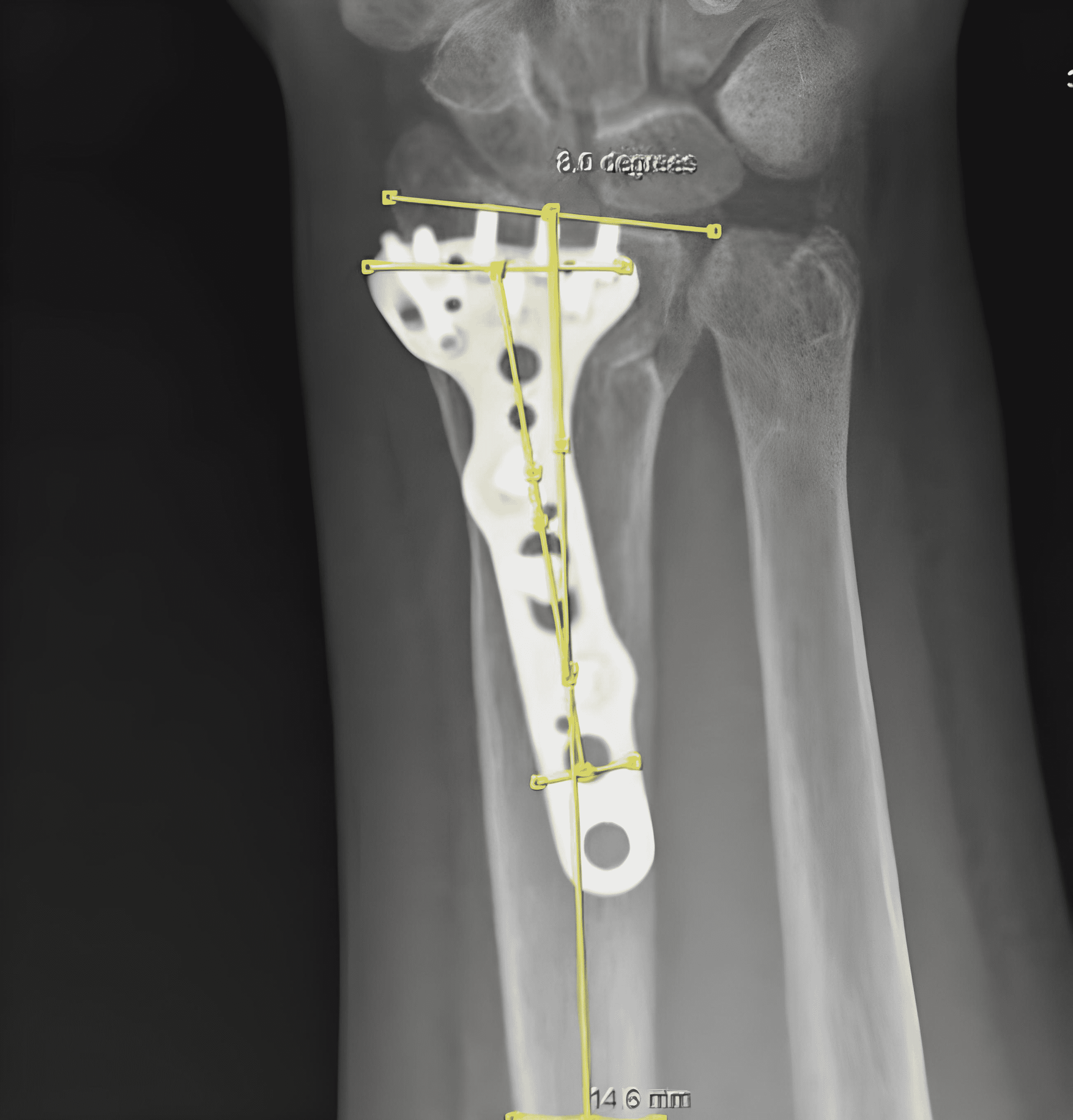Cureus Evaluation of the Coronal Malposition of the Volar Locking