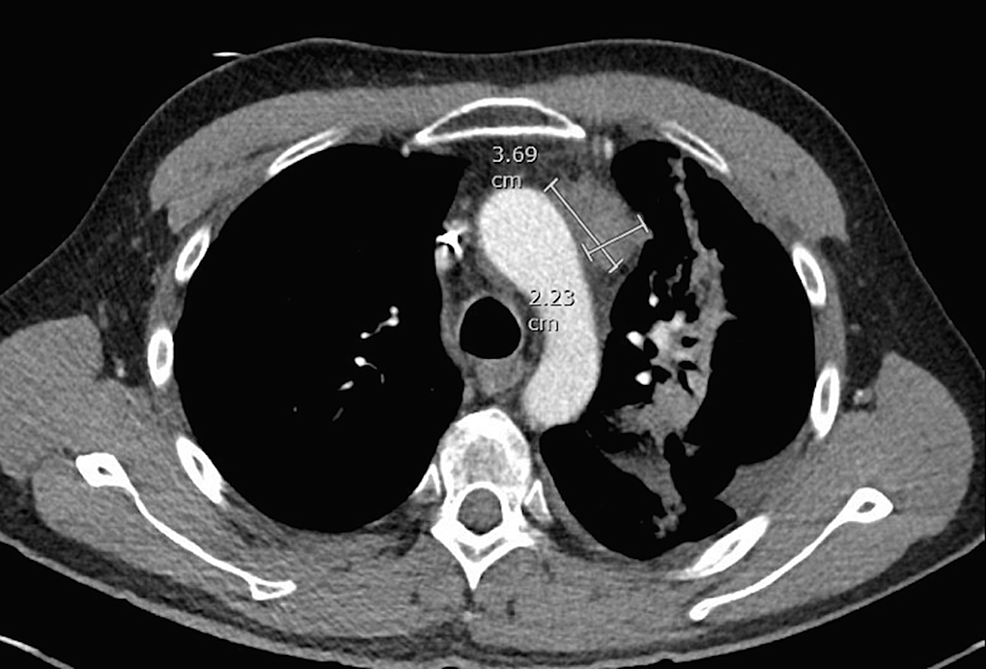Computed-tomography-(CT)-scan-of-the-chest-showing-the-anterior-mediastinal-mass