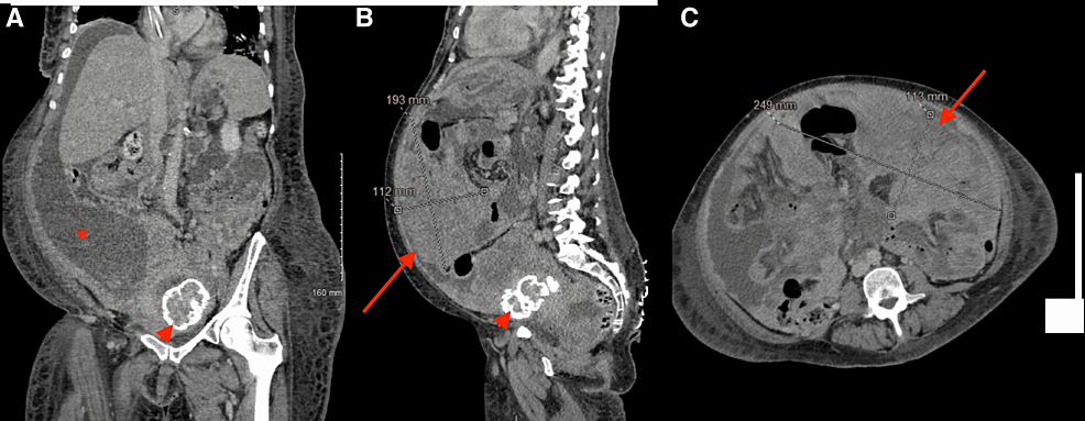 CT-scan-of-the-abdomen-and-pelvis.-(A)-A-coronal-section-showing-ascites-(asterisk),-the-liver-is-seen-without-metastatic-disease,-normal-size,-and-contour.-(B)-A-sagittal-section-shows-a-large-peritoneal-mass-(arrow)-of-19-x-25-x-11-cm,-also-seen-on-(C)-the-axial-section.-Arrowhead-points-toward-an-incidental-calcified-fibroid-seen-in-(A)-and-(B).