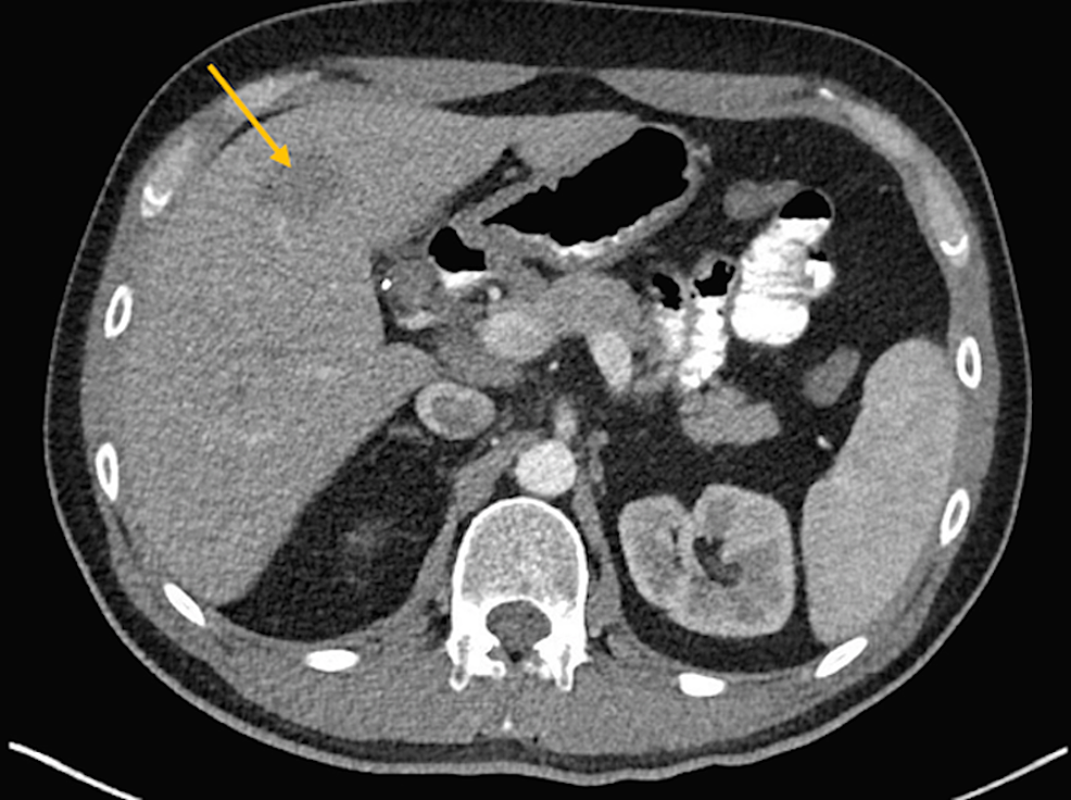 Computed-tomography-(CT)-scan-of-the-liver-showing-a-mass-in-the-left-lobe