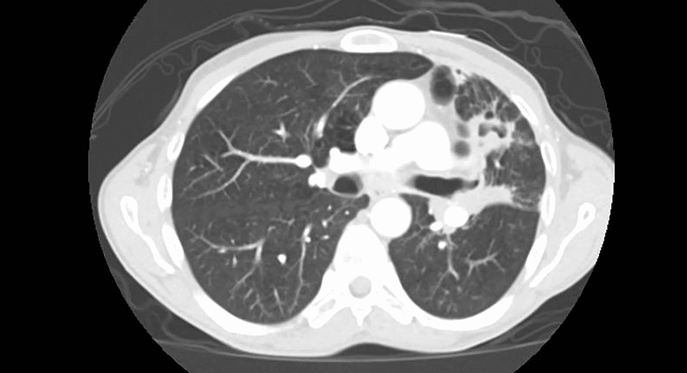 CT-of-the-chest-showing-tree-in-bud-opacities-bilaterally