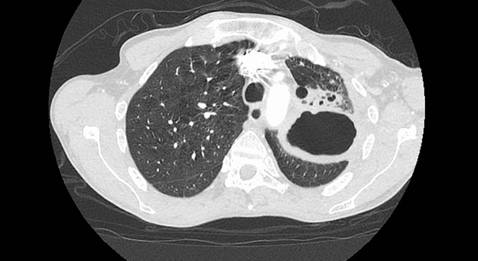 CT-of-the-chest-showing-6.8-X-5.1-X-6.7-cm-cavitary-lesion-in-the-left-hilum-and-left-upper-lobe
