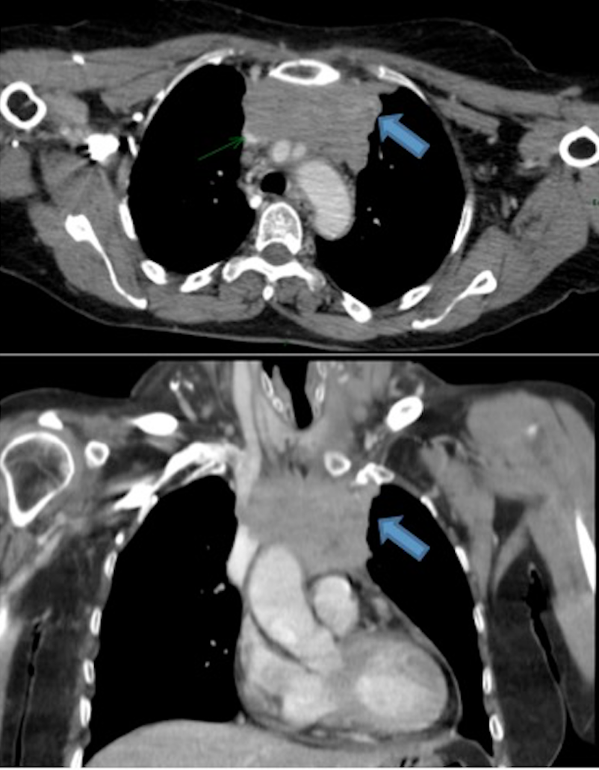 Cureus Metastatic Thymic Carcinoma with Long Survival After Treatment