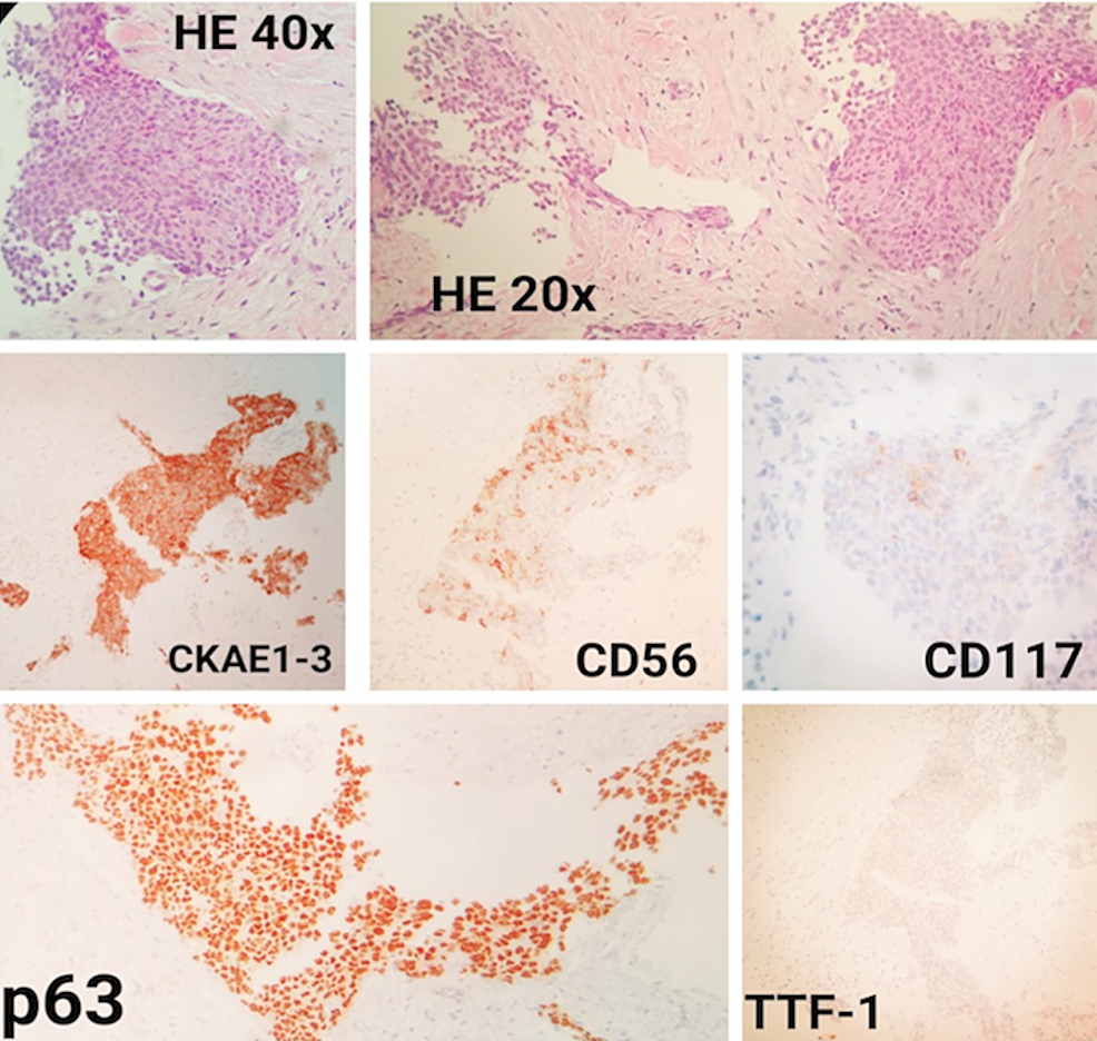 Metastatic Thymic Carcinoma with Long Survival After Treatment with