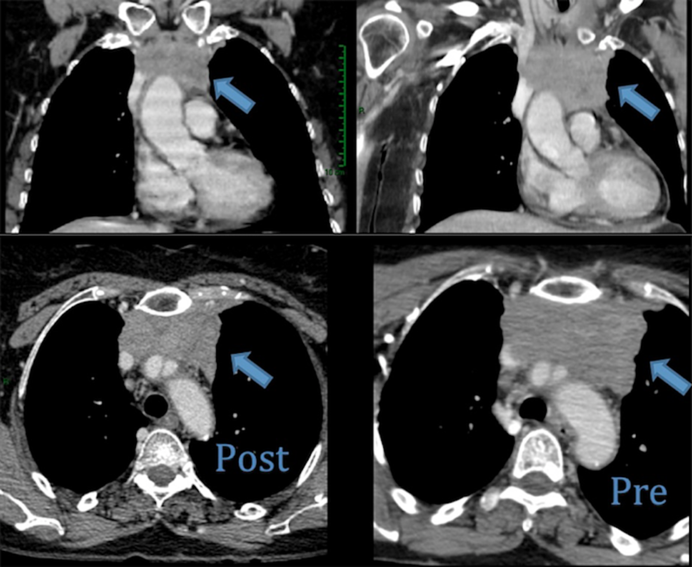 Cureus Metastatic Thymic Carcinoma with Long Survival After Treatment