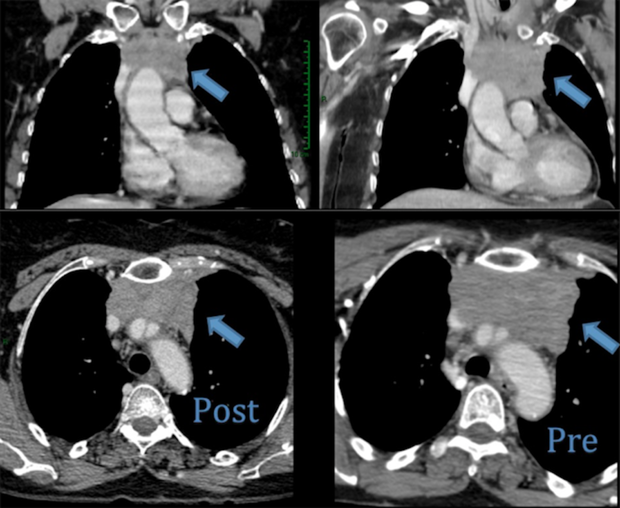 Cureus Metastatic Thymic Carcinoma with Long Survival After Treatment