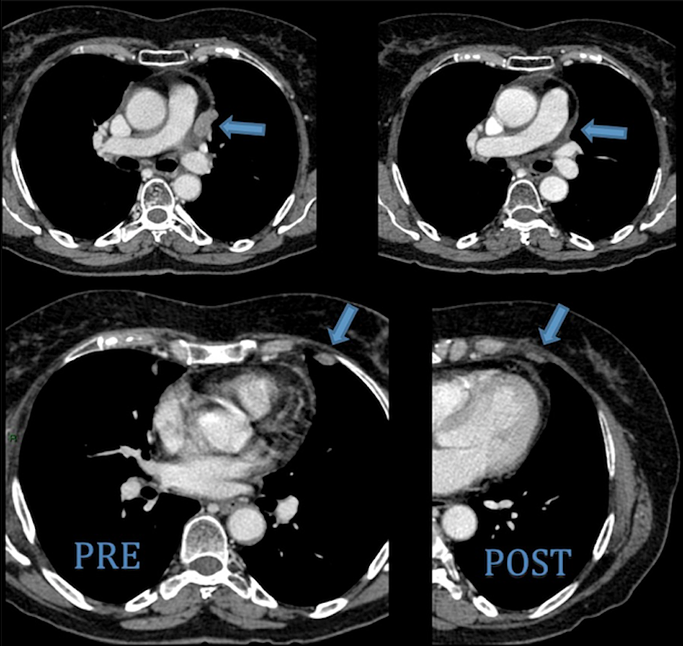 Metastatic Thymic Carcinoma with Long Survival After Treatment with Sunitinib Cureus