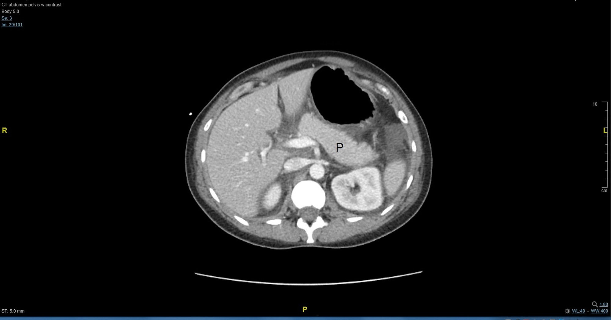 Cureus A Case of Acute Pancreatitis in Hemolysis, Elevated Liver