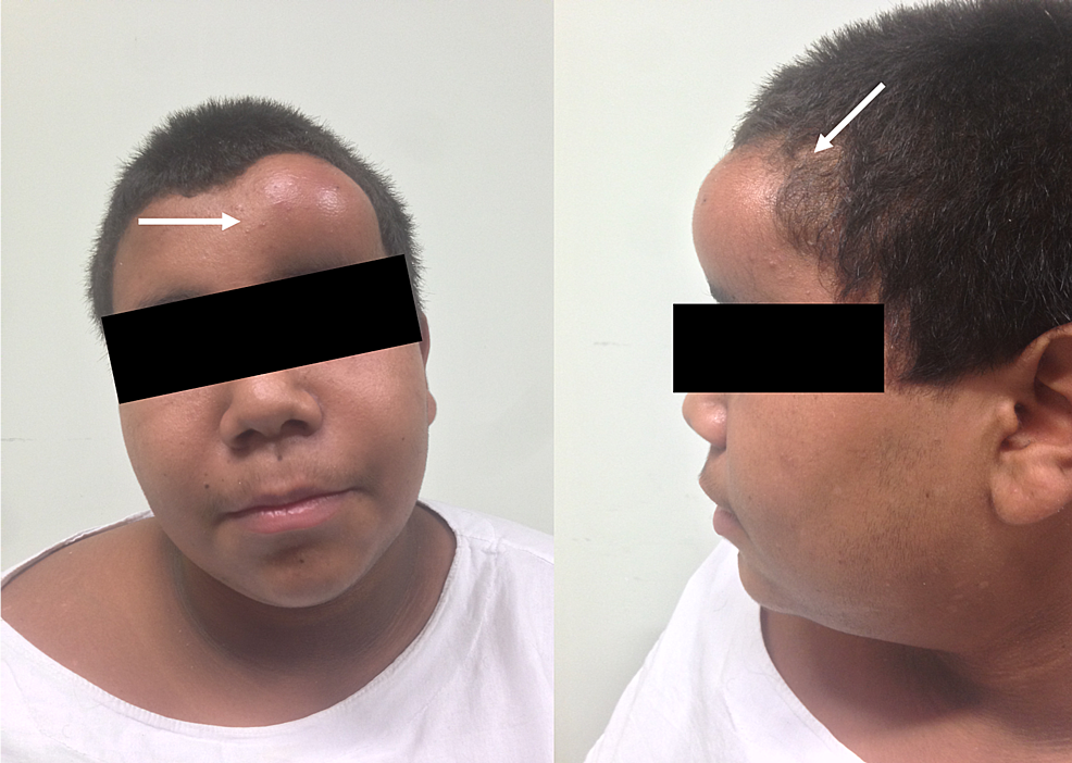 Neurosurgical Management of Pott’s Puffy Tumor in an Obese Adolescent