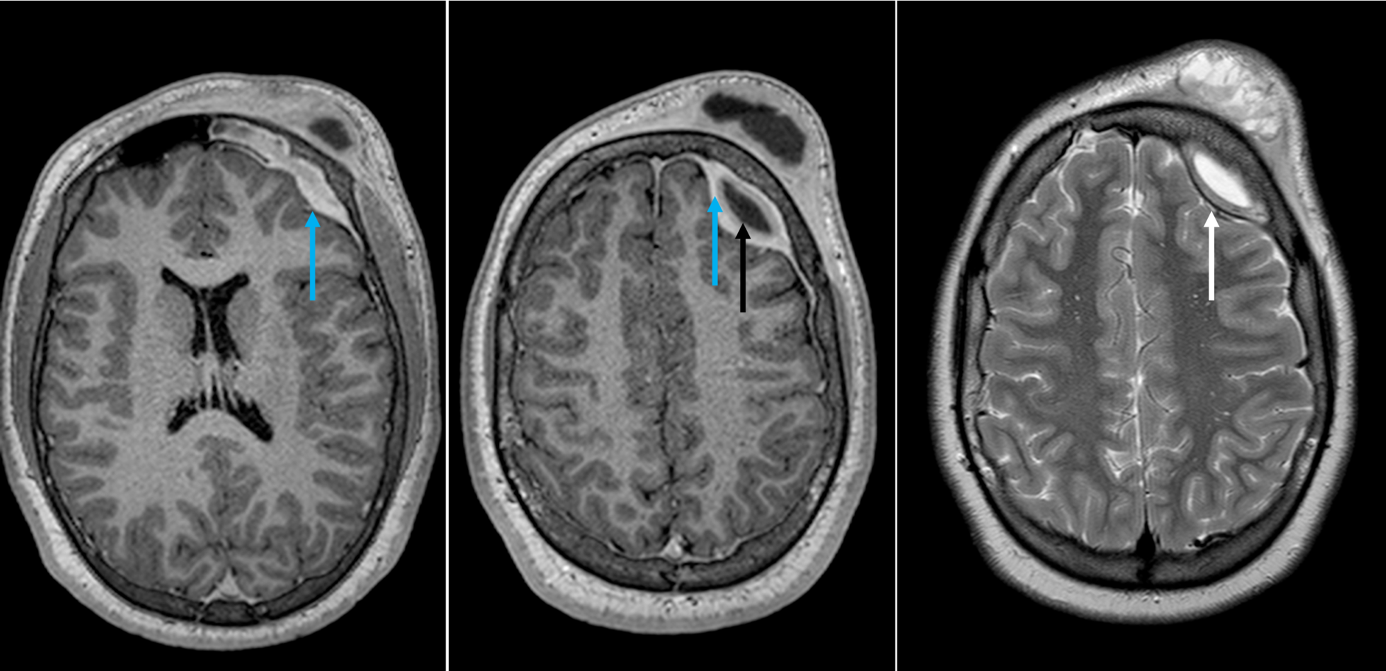 neurosurgical management of potts puffy tumor in