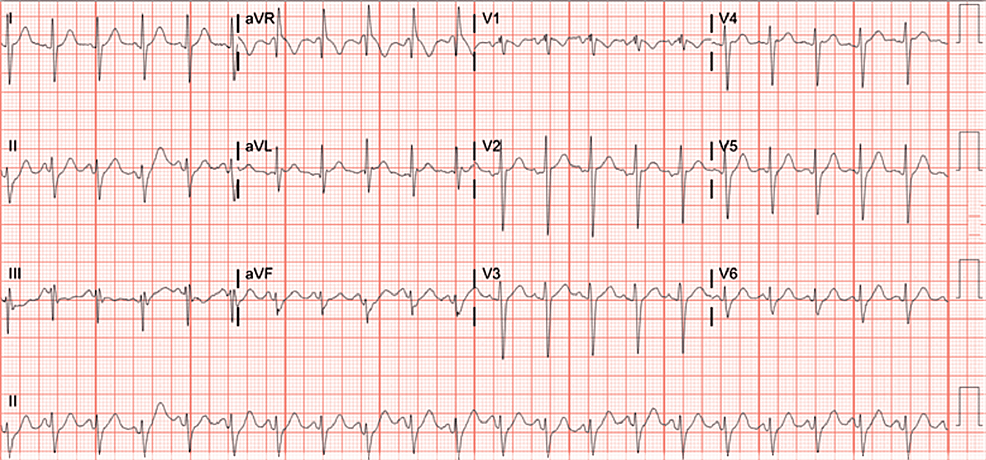 Electrocardiogram-(EKG)-showing-signs-of-sinus-tachycardia