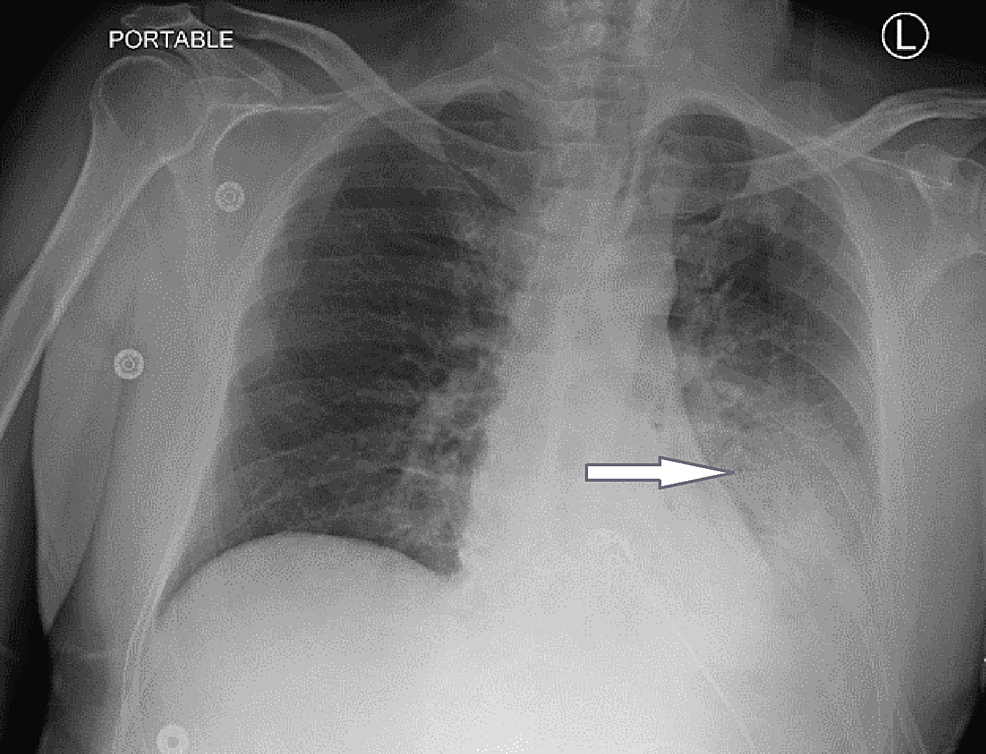 Chest-X-ray-showing-pulmonary-infiltrates-on-the-left
