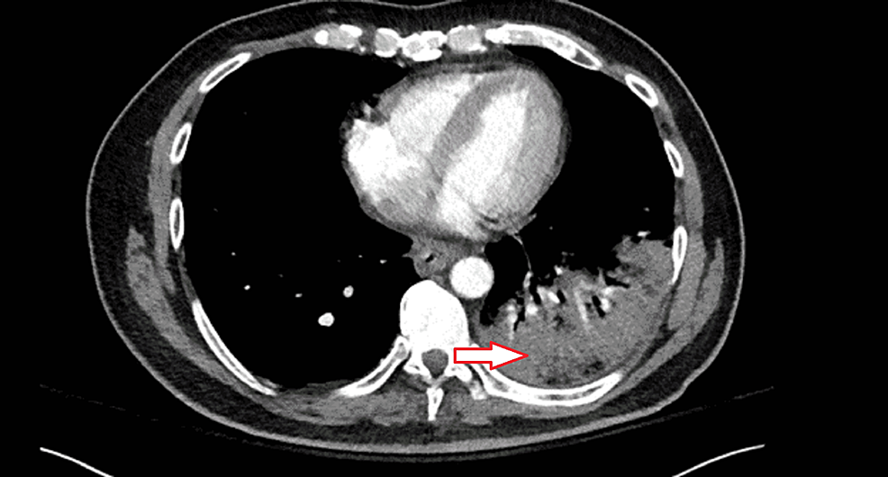 CT-angiogram-of-the-chest
