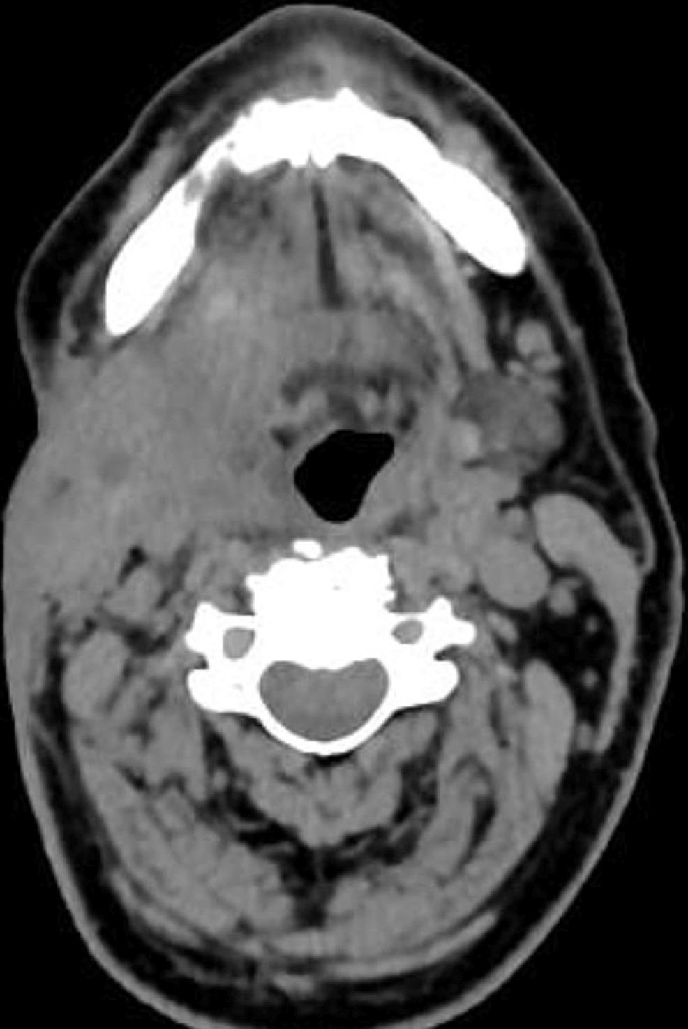 Scannographic-presentation-of-the-right-submandibular-swelling-(heterogeneous-mass-with-irregular-contours-extending-into-the-right-parapharyngeal-space-and-palatine-fossa).