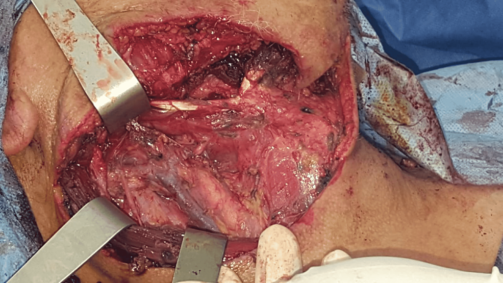 Post-operative-aspect-after-complete-resection-of-the-lesion.